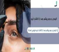 کبودی و ورم چشم بعد از کاشت ابرو
