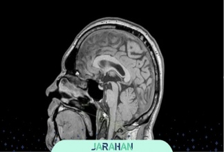 ناهنجاری آرنولد کیاری