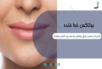 بوتاکس خط خنده