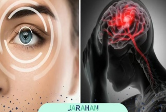 تومور مغزی پشت چشم چیست؟