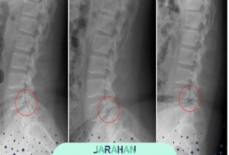 عوارض و خطرات جراحی تنگی کانال نخاعی