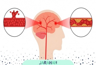 تفاوت سکته مغزی با خونریزی مغزی چیست؟