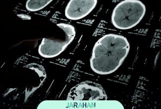 تومور اپاندیموما