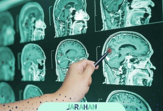 آنوریسم مغزی کاذب