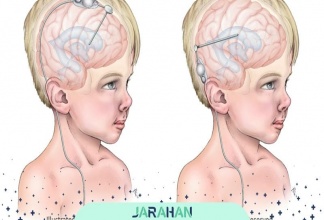 جراحی هیدروسفالی