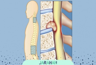 طول عمر بیماران تومور نخاعی