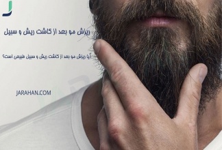 ریزش مو بعد از کاشت ریش و سبیل