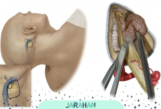 تومور الیگودندروگلیوما