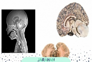 تومور شوانوم یا شوانوما چیست؟