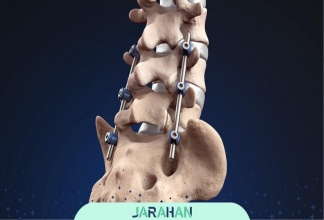 عمل فیوژن ستون فقرات و کمر چیست؟