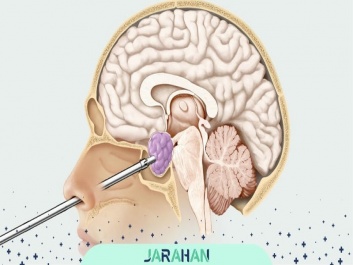 هزینه عمل هیدروسفالی