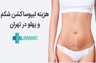 هزینه جراحی لیپوساکشن شکم و پهلو در تهران