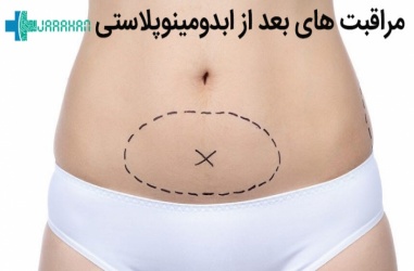 مراقبت های بعد از ابدومینوپلاستی یا عمل زیبایی شکم