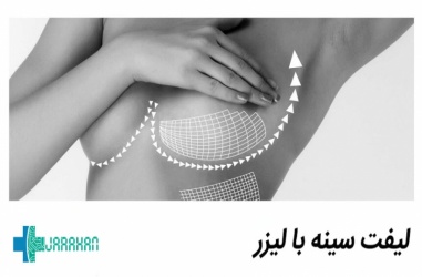 همه چیز درباره لیفت سینه با لیزر و هزینه آن