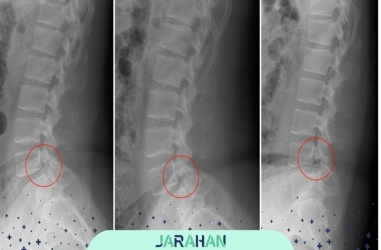 عوارض و خطرات جراحی تنگی کانال نخاعی