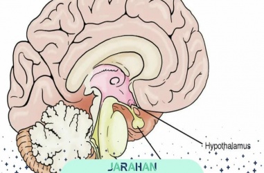 تومور غده هیپوتالاموس