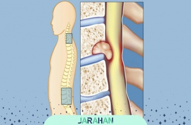 طول عمر بیماران تومور نخاعی
