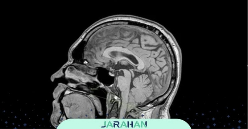 ناهنجاری آرنولد کیاری