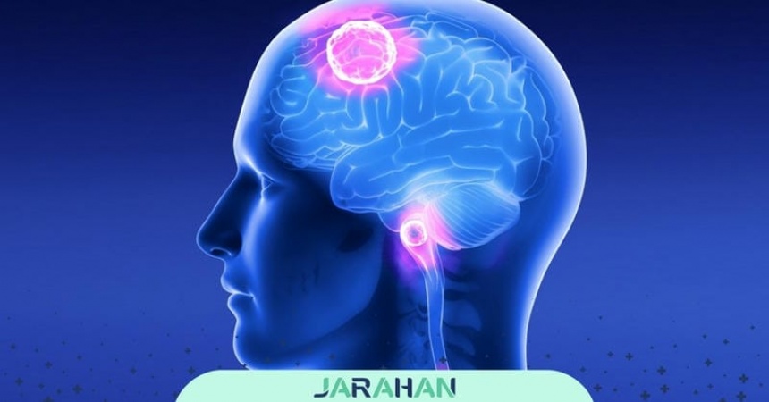 تومور آستروسیتوما
