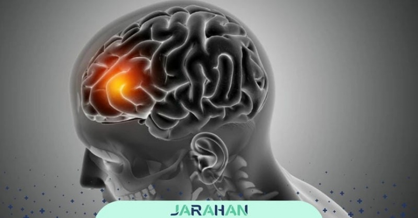 آیا آنوریسم مغزی کشنده است؟