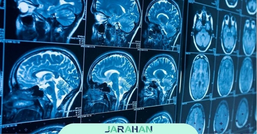 آتروفی مغزی چیست؟