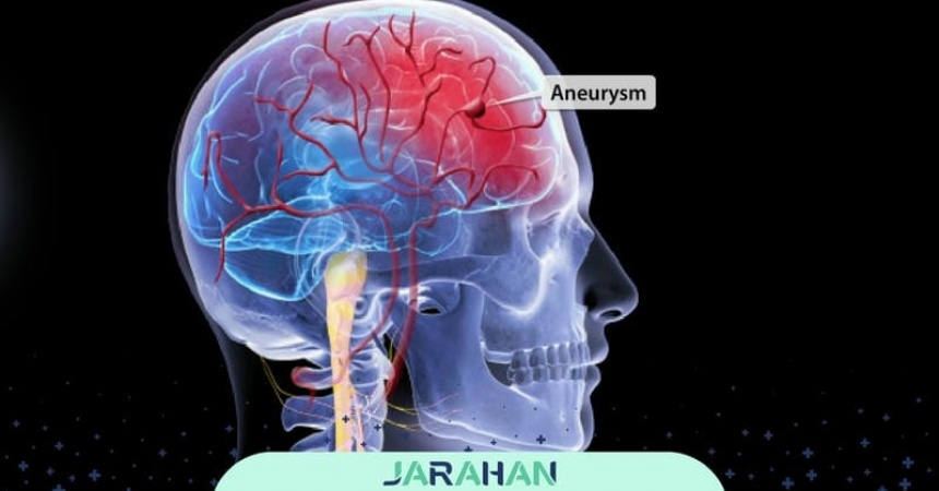 درصد موفقیت عمل جراحی آنوریسم مغزی چقدر است؟